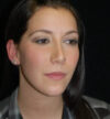 Rhinoplasty case #13190