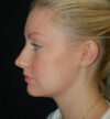 Rhinoplasty case #13195