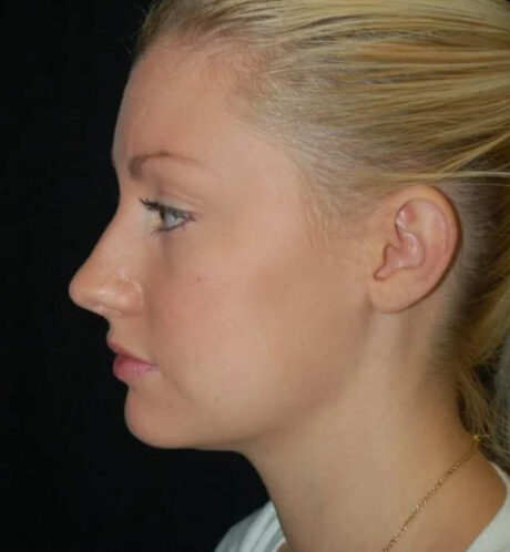 Rhinoplasty case #13195