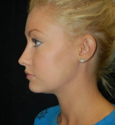 Rhinoplasty case #13195