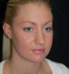 Rhinoplasty case #13195