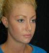 Rhinoplasty case #13195