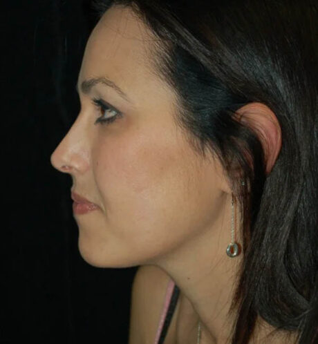 Rhinoplasty case #13200