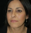 Rhinoplasty case #13200