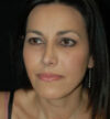 Rhinoplasty case #13200