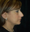 Rhinoplasty case #13209