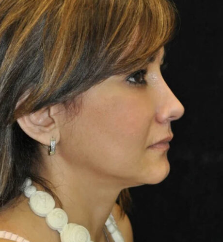 Rhinoplasty case #13209