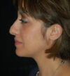 Rhinoplasty case #13213