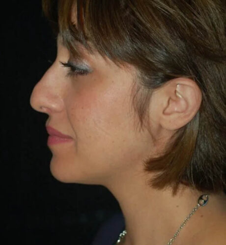 Rhinoplasty case #13213