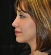Rhinoplasty case #13213