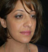 Rhinoplasty case #13213