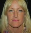 Rhinoplasty case #13218