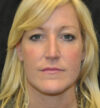 Rhinoplasty case #13218