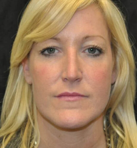 Rhinoplasty case #13218