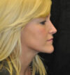 Rhinoplasty case #13218