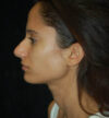 Rhinoplasty case #13225