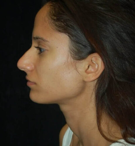 Rhinoplasty case #13225