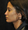 Rhinoplasty case #13225