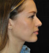 Rhinoplasty case #13228