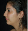 Rhinoplasty case #13231