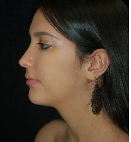 Rhinoplasty case #13231