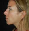Rhinoplasty case #13235