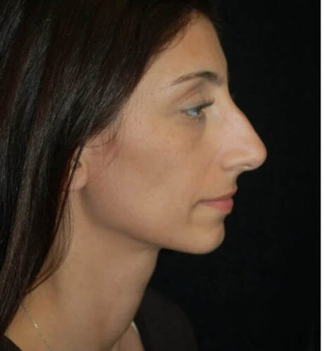 Rhinoplasty case #13238