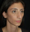 Rhinoplasty case #13238