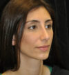 Rhinoplasty case #13238