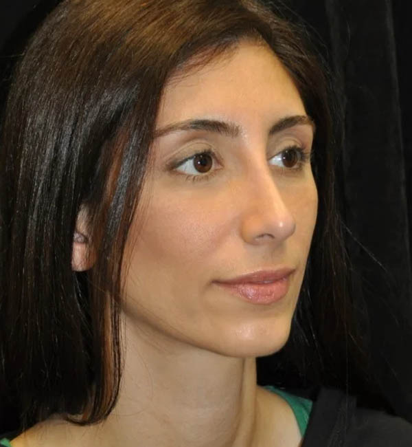 Rhinoplasty case #13238