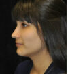 Rhinoplasty case #13243