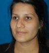 Rhinoplasty case #13243