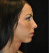 Facial Fat Grafting case #13248