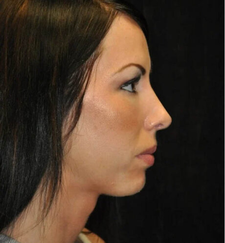 Facial Fat Grafting case #13248