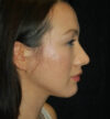 Rhinoplasty case #13256