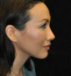 Rhinoplasty case #13256