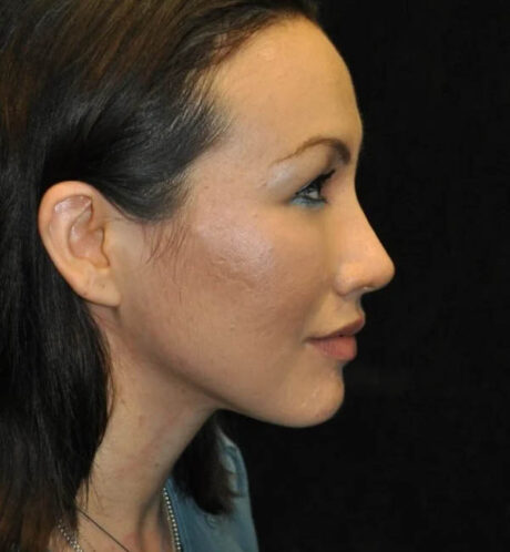 Rhinoplasty case #13256
