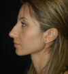 Rhinoplasty case #13259