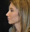 Rhinoplasty case #13259