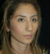 Rhinoplasty case #13259