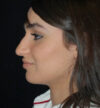 Rhinoplasty case #13264