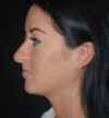 Rhinoplasty case #13267