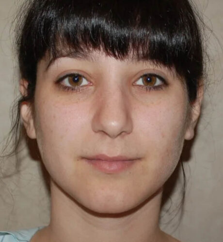 Rhinoplasty case #13272
