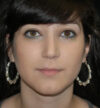 Rhinoplasty case #13272