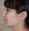 Rhinoplasty case #13272