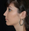 Rhinoplasty case #13272