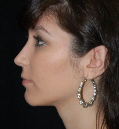 Rhinoplasty case #13272