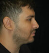 Rhinoplasty case #13280