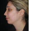Rhinoplasty case #13289