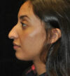 Rhinoplasty case #13292